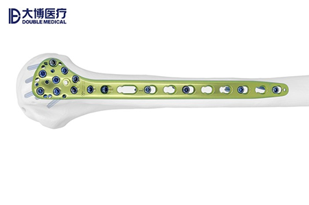 金属锁定接骨板系统